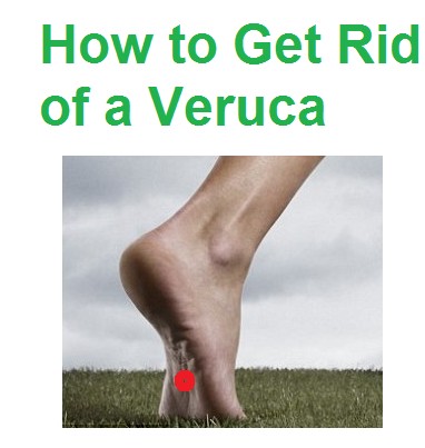 How to get rid of a veruca