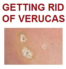Getting Rid of Verucas