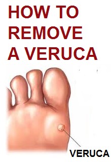 How to Remove a Veruca