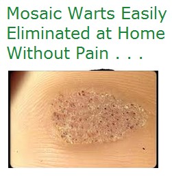 Mosaic Warts