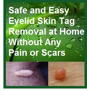 removing skin tags on eyelids at home