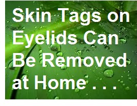 Skin Tag on Eyelid