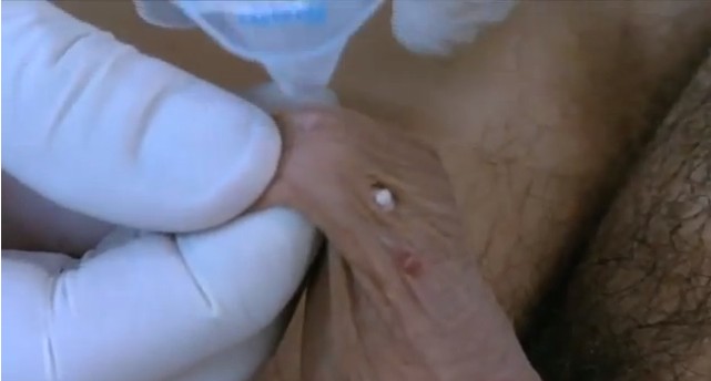 Doctor freezes skin tags