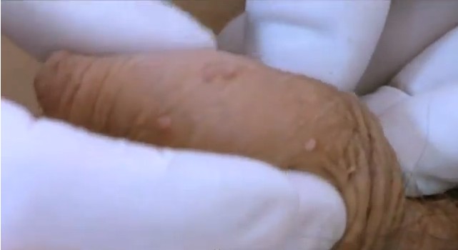 Doctor locates skin tags on penis